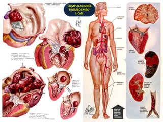 COMPLICACIONES
 TROMBOEMBO-
    LICAS.




                 22
 