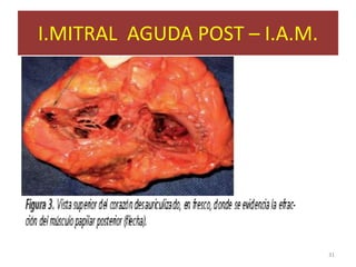 I.MITRAL AGUDA POST – I.A.M.




                               31
 