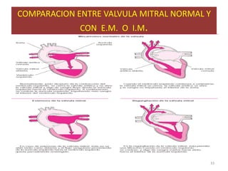COMPARACION ENTRE VALVULA MITRAL NORMAL Y
             CON E.M. O I.M.




                                        33
 