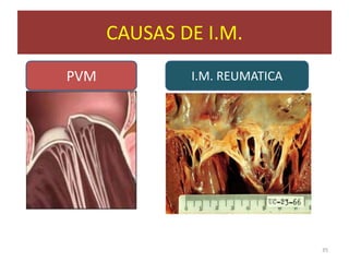 CAUSAS DE I.M.
PVM           I.M. REUMATICA




                               35
 
