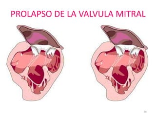 PROLAPSO DE LA VALVULA MITRAL




                            36
 