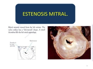 ESTENOSIS MITRAL.




                    4
 