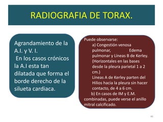 RADIOGRAFIA DE TORAX.

                         Puede observarse:
Agrandamiento de la          a) Congestión venosa
A.I. y V. I.                 pulmonar,             Edema
                             pulmonar y Líneas B de Kerley.
 En los casos crónicos       (Horizontales en las bases
la A.I esta tan              desde la pleura parietal 1 a 2
dilatada que forma el        cm.)
                             Líneas A de Kerley parten del
borde derecho de la          Hilios hacia la pleura sin hacer
silueta cardiaca.            contacto, de 4 a 6 cm.
                             b) En casos de IM y E.M.
                         combinadas, puede verse el anillo
                         mitral calcificado.

                                                                46
 