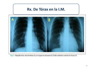 Rx. De Tórax en la I.M.




                          47
 