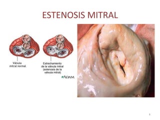 ESTENOSIS MITRAL




                   8
 