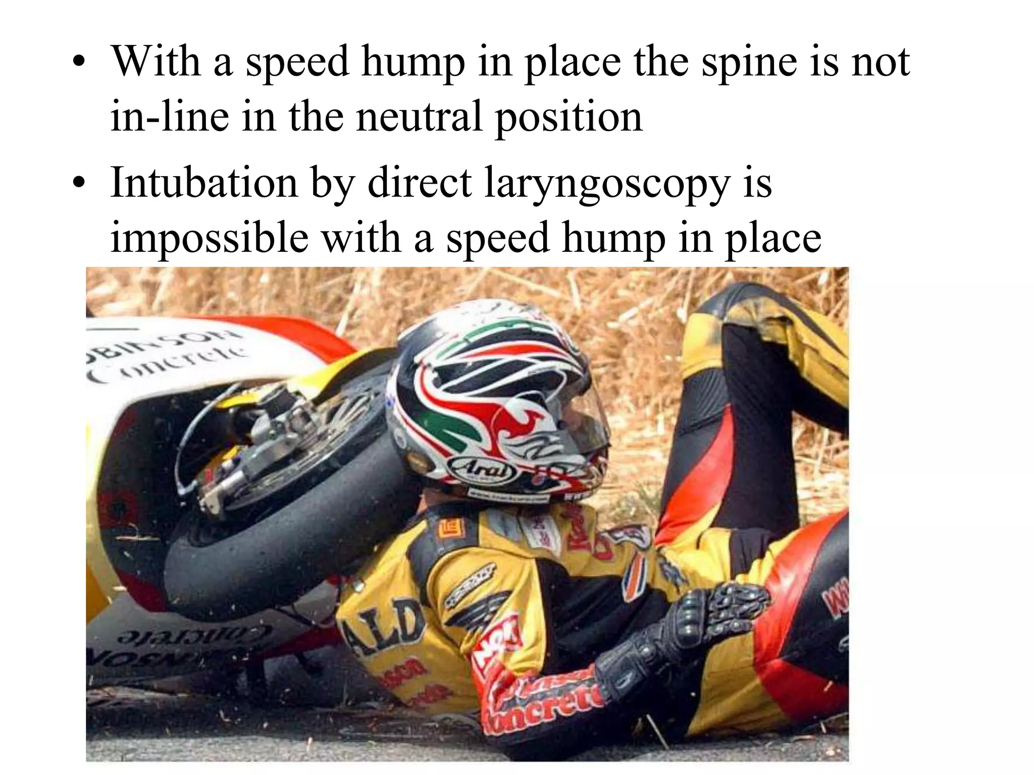 • With a speed hump in place the spine is not
in-line in the neutral position
• Intubation by direct laryngoscopy is
impossible with a speed hump in place
 