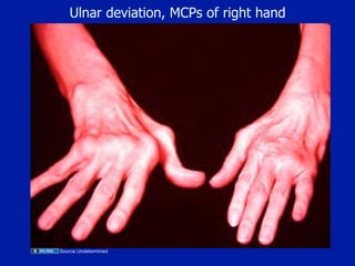 Mpcjs Hand 12.01.08(a): Rheumatoid Arthritis/Pathogenesis and Clinical ...