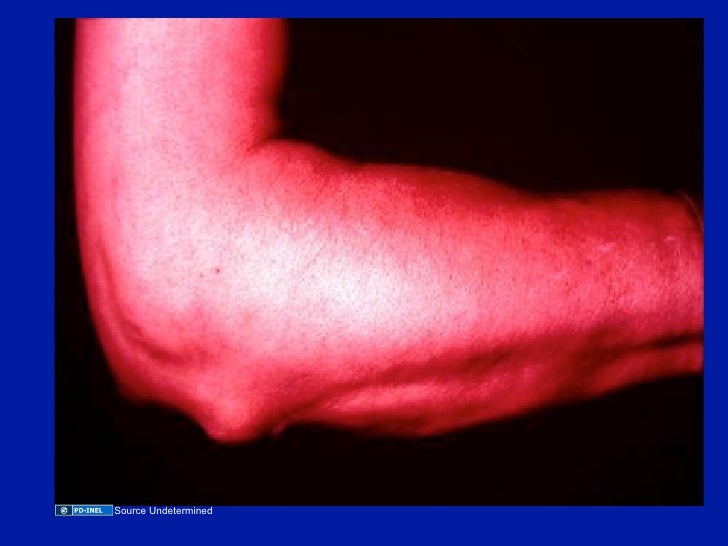 12.01.08(b): Immunosuppressive Therapies for Rheumatic 