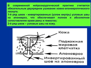 В современной нейрохирургической практике считается
обязательным двухрядное ушивание кожно-апоневротического
лоскута.
1-й ряд швов - инвертированные (узлом внутрь) узловые швы
на апоневроз, что обеспечивает полное и абсолютное
сопоставление краев раны и гемостаз;
2-й ряд швов – узловые швы на кожу.
 