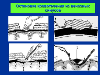 Остановка кровотечения из венозныхОстановка кровотечения из венозных
синусовсинусов
 