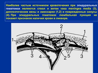Наиболее частым источником кровотечения при эпидуральных
гематомах являются ствол и ветви vasa meningea media (3),
диплоэтические вены и эмиссарии (1,2) и поврежденные синусы
(4). При эпидуральных гематомах люмбальная пункция не
покажет признаков наличия крови в ликворе.
 