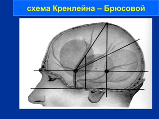 схема Кренлейна – Брюсовой
 