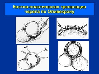 Костно-пластическая трепанацияКостно-пластическая трепанация
черепа по Оливекронучерепа по Оливекрону
 
