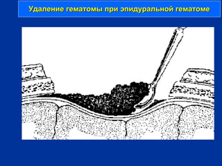 Удаление гематомы при эпидуральной гематомеУдаление гематомы при эпидуральной гематоме
 