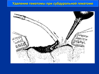 Удаление гематомы при субдуральной гематомеУдаление гематомы при субдуральной гематоме
 