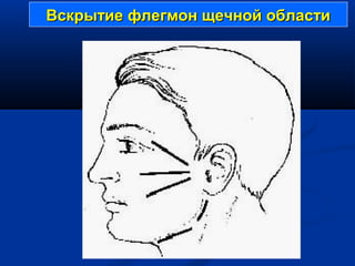 Вскрытие флегмон щечной областиВскрытие флегмон щечной области
 