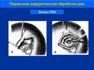 Первичная хирургическая обработка ранПервичная хирургическая обработка ран
Этапы ПХО
 