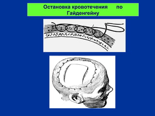 Остановка кровотечения по
Гайденгейну
 