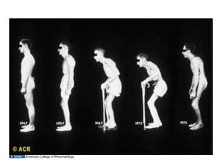 12.02.09(a): Other Inflammatory Arthritides | PDF
