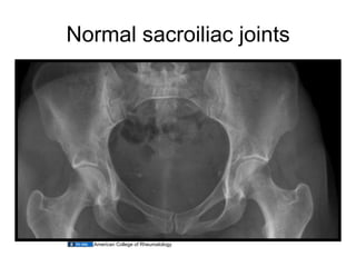 12.02.09(a): Other Inflammatory Arthritides | PDF