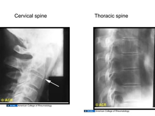 12.02.09(a): Other Inflammatory Arthritides | PDF