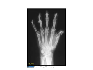 12.02.09(a): Other Inflammatory Arthritides | PDF