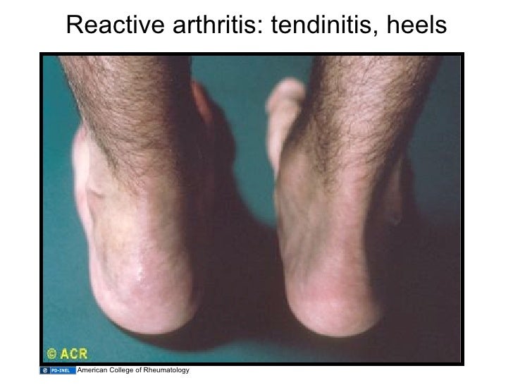 12.02.09(a) Other Inflammatory Arthritides