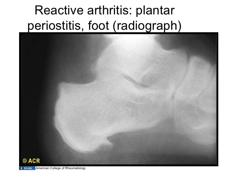 12.02.09(a) Other Inflammatory Arthritides