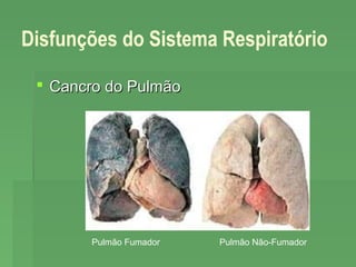 Disfunções do Sistema Respiratório
 Cancro do Pulmão

Pulmão Fumador

Pulmão Não-Fumador

 