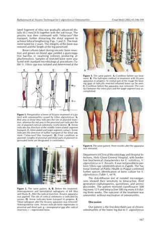 Barbarossa et al: Ilizarov Technique for V alginolyticus Osteomyelitis                         Croat Med J 2002;43:346-349



lated fragment of tibia was gradually advanced dis-
tally (0.5 mm/24 h) together with the soft tissue. The
process was then continued with “relay-race”-like
transport, further distracting the distal segment to
achieve bifocal lengthening (Figs. 1 and 2). The treat-
ment lasted for 2 years. The integrity of the bone was
restored and the length of the leg preserved.
      Bone cultures taken during necrotic bone resec-
tion and grown on blood agar yielded a gram-nega-
tive bacillus in swarming colonies producing al-
pha-hemolysis. Samples of resected bone were ana-
lyzed with standard microbiological procedures (Ta-
ble 1). Vibrio spp was isolated and determined at the



                                                                  Figure 3. The same patient. A. Condition before our treat-
                                                                  ment. B. The half-open method of treatment with Ilizarov
                                                                  apparatus in progress. In central part of the image the bear-
                                                                  ing (gap) of radically resected inflamed bone can be seen.
                                                                  C. Condition before the apparatus was removed. The con-
                                                                  tact between the intercalary and the target segment was ac-
                                                                  complished.




Figure 1. Preoperative scheme of Ilizarov treatment of a pa-
tient with osteomyelitis caused by Vibro alginolyticus. A.
Red area in distal tibia indicates the site of planned resec-
tion, whereas the red area in the proximal part indicates the
site of planned cortical osteotomy (corticotomy). B. Arrow
indicates the direction of the middle (intercalated) segment
transport. C. Intercalated and target segment contact. Arrow
indicates the direction of further transport of the distal seg-
ment (“relay-race”-like transport). D. Final condition as
planned. Lengths of proximal and distal parts of planned re-
generated bone are designated in centimeters.

                                                                  Figure 4. The same patient, three months after the apparatus
                                                                  was removed.

                                                                  Department of Clinical Microbiology and Hospital In-
                                                                  fections, Holy Ghost General Hospital, with border-
                                                                  line biochemical characteristics for V. vulnificus, V.
                                                                  alginolyticus or V. fluvialis. It was not possible to per-
                                                                  form Vibrio spp subidentification in Zagreb. The Na-
                                                                  tional Institute of Public Health in Prague confirmed
                                                                  further species identification of bone culture for V.
                                                                  alginolyticus (Table 1, ref 9).
                                                                       The disk-diffusion test of isolated microorgan-
                                                                  isms showed their sensitivity to tetracycline, third
                                                                  generation cephalosporins, quinolones, and amino-
                                                                  glycosides. The patient received ciprofloxacin 500
Figure 2. The same patient. A, B. Before the treatment.           mg every 12 h and tetracycline 500 mg every 6 h dur-
Anteroposterior and laterolateral radiograms of left tibia        ing three weeks. The outcome of the treatment was
and fibula. C. After the radical resection. Ilizarov apparatus
was applied. The site of cortical osteotomy is indicated by
                                                                  uneventful, without reactivation of osteomyelitis.
arrows. D. Arrow indicates bone transport in progress. E.
Tibial radiogram after the Ilizarov apparatus was removed.             Discussion
Anteroposterior view. Arrows indicate bone regenerates in
proximal and distal part. g – postoperative gap after radical         Our patient is the first described case of chronic
resection; r – regenerated bone.                                  osteomyelitis of the lower leg due to V. alginolyticus


                                                                                                                          347
 
