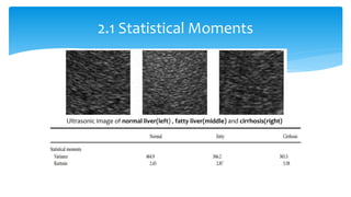 2.1 Statistical Moments
Ultrasonic image of normal liver(left) , fatty liver(middle) and cirrhosis(right)
 