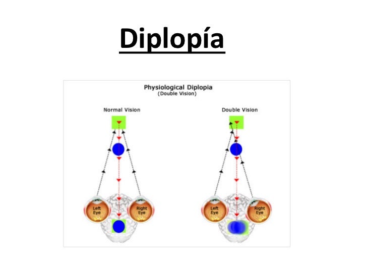 120604 diplopía pdf