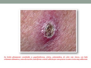 La lesión plenamente constituida es papulotuberosa, cónica, asintomática, de color rojo vinoso, con halo
eritemato-edematoso y una ulceración crateriforme central cubierta por una gruesa escamo-costra muy adherente
 