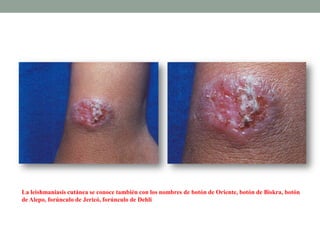 La leishmaniasis cutánea se conoce también con los nombres de botón de Oriente, botón de Biskra, botón
de Alepo, forúnculo de Jericó, forúnculo de Dehli
 
