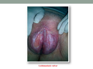 Leishmaniasis vulvar
 