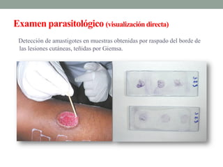 Examen parasitológico (visualización directa)
 Detección de amastigotes en muestras obtenidas por raspado del borde de
 las lesiones cutáneas, teñidas por Giemsa.
 