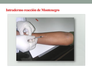 Intradermo reacción de Montenegro
 