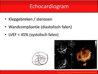 Echocardiogram

• Klepgebreken / stenosen
• Wandcompliantie (diastolisch falen)
• LVEF < 45% (systolisch falen)




                              Kjetil Lenes http://en.wikipedia.org/wiki/Echocardiography
 