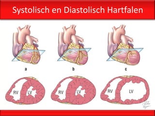 Systolisch en Diastolisch Hartfalen
 