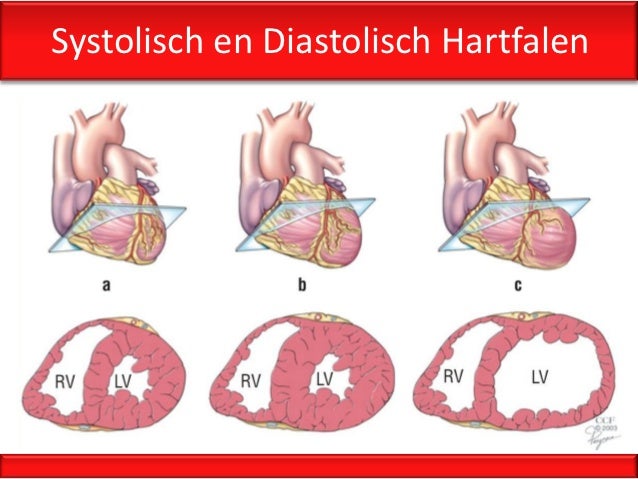 klachten bij hartfalen