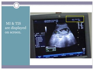 •MI & TIS
are displayed
on screen.
 
