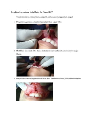 Frenektomi conventional Insisal Below the Clamp (IBC)2
Untuk minimalisasi perdarahan pada pembedahan yang menggunakan scalpel.
1. Dengan menggunakan satu clamp yang dijepitkan sejajar bibir.
2. Modifikasi insisi pada IBC, Insisi dilakukan di sebelah bawah dan menempel sejajar
klamp.
3. Penjahitan dilakukan segera setelah insisi pada daerah mucolabial fold dan mukosa bibir.
 