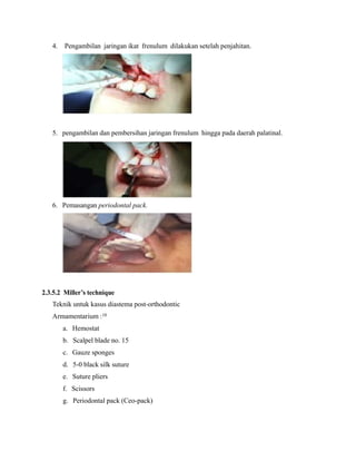 4. Pengambilan jaringan ikat frenulum dilakukan setelah penjahitan.
5. pengambilan dan pembersihan jaringan frenulum hingga pada daerah palatinal.
6. Pemasangan periodontal pack.
2.3.5.2 Miller’s technique
Teknik untuk kasus diastema post-orthodontic
Armamentarium :10
a. Hemostat
b. Scalpel blade no. 15
c. Gauze sponges
d. 5-0 black silk suture
e. Suture pliers
f. Scissors
g. Periodontal pack (Ceo-pack)
 
