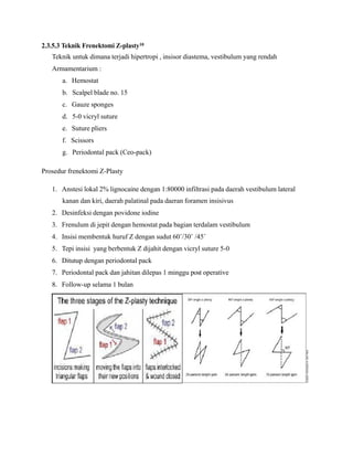 2.3.5.3 Teknik Frenektomi Z-plasty10
Teknik untuk dimana terjadi hipertropi , insisor diastema, vestibulum yang rendah
Armamentarium :
a. Hemostat
b. Scalpel blade no. 15
c. Gauze sponges
d. 5-0 vicryl suture
e. Suture pliers
f. Scissors
g. Periodontal pack (Ceo-pack)
Prosedur frenektomi Z-Plasty
1. Anstesi lokal 2% lignocaine dengan 1:80000 infiltrasi pada daerah vestibulum lateral
kanan dan kiri, daerah palatinal pada daeran foramen insisivus
2. Desinfeksi dengan povidone iodine
3. Frenulum di jepit dengan hemostat pada bagian terdalam vestibulum
4. Insisi membentuk huruf Z dengan sudut 60˚/30˚ /45˚
5. Tepi insisi yang berbentuk Z dijahit dengan vicryl suture 5-0
6. Ditutup dengan periodontal pack
7. Periodontal pack dan jahitan dilepas 1 minggu post operative
8. Follow-up selama 1 bulan
 