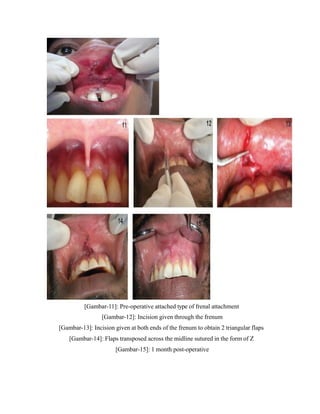 [Gambar-11]: Pre-operative attached type of frenal attachment
[Gambar-12]: Incision given through the frenum
[Gambar-13]: Incision given at both ends of the frenum to obtain 2 triangular flaps
[Gambar-14]: Flaps transposed across the midline sutured in the form of Z
[Gambar-15]: 1 month post-operative
 