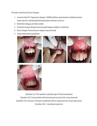 Prosedur frenektomi Electro Surgery
1. Anastesi lokal 2% lignocaine dengan 1:80000 infiltrasi pada daerah vestibulum lateral
kanan dan kiri, daerah palatinal pada daeran foramen insisivus
2. Desinfeksi dengan povidone iodine
3. Frenulum di jepit dengan hemostat pada bagian terdalam vestibulum
4. Eksisi dengan Electrocautery dengan loop electrode
5. Tanpa dilakukakan penjahitan
[Gambar-21]: Pre-operative attached type of frenal attachment
[Gambar-22]: Frenum held with hemostat and excised with a loop electrode
[Gambar-23]: Excision of frenum completed with no requirement for suture placement
[Gambar-24]: 1 month post operative
 