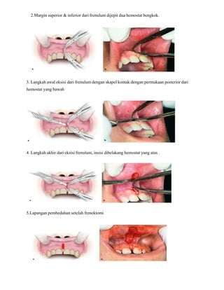 2.Margin superior & inferior dari frenulum dijepit dua hemostat bengkok.
3. Langkah awal eksisi dari frenulum dengan skapel kontak dengan permukaan posterior dari
hemostat yang bawah
4. Langkah akhir dari eksisi frenulum, insisi dibelakang hemostat yang atas .
5.Lapangan pembedahan setelah frenektomi
 