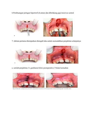 6.Pembuangan jaringan hipertrofi di antara dan dibelakang gigi insisivus sentral
7. Jahitan pertama ditempatkan ditengah luka untuk memudahkan penjahitan selanjutnya
a. setelah penjahitan. b. gambaran klinis postoperative 3 bulan kemudian
 