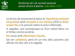 Síndrome de l’ull vermell sectorial
          sense clínica d’alarma Cas clínic 1.2.1




La forma de presentació típica és hiperèmia sectorial
conjuntival amb sensació a cos estrany (SCE) o dolor
ocular lleu a la pressió sobre la zona inflamada.
A vegades, pot acompanyar-se d’un nòdul blanc en
el limbo cornio-escleral.
No cursa amb alteracions visuals.
Sol ser unilateral, però en un treç dels pacients pot
afectar els dos ulls a la vegada.
 