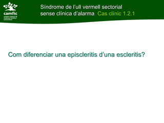 Síndrome de l’ull vermell sectorial
           sense clínica d’alarma Cas clínic 1.2.1




Com diferenciar una episcleritis d’una escleritis?
 